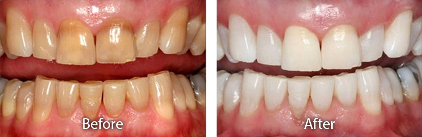 Teeth Whitening Tempe AZ