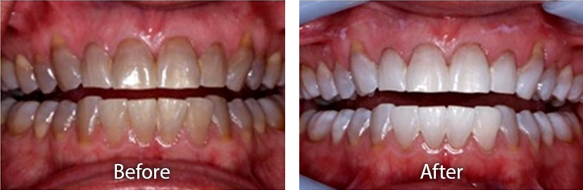 Tempe AZ Teeth Whitening Dentist